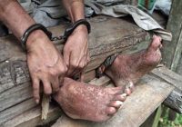 Masih Ada ODGJ Dipasung, Komnas HAM Ungkap Penyebabnya