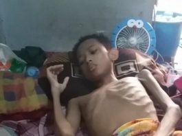 Tak Tega, ABG di Pengambangan Alami Kanker Tulang, Kaki Membesar seperti Balon