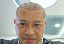 Transplantasi Rambut, Cara Permanen Atasi Kebotakan dan Kerontokan