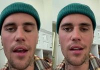 Pakar Saraf Oxford Brookes University Sebut Ramsay Hunt Syndrom atau Lumpuh Wajah Sebelah Justin Bieber Bisa Sembuh dengan Terapi ini