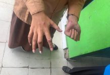 Dinkes Pantau Langsung Siswa Penderita Scabies di Kelayan Banjarmasin