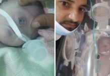Heboh Bayi Bermata Satu Lahir di Yaman, Pakar Ungkap Fakta Mengejutkan