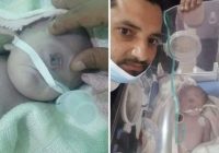 Heboh Lagi Bayi Mata Satu Lahir di Yaman, Cek Fakta