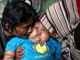Bukan Susu Kental Manis Pemicu Obesitas Bayi Kenzi, Kemenkes Sebut Kasus Langka