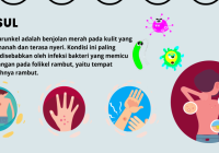 Bisul Menyerang Siapa Saja, Perhatikan Penyebab dan Gejalanya, Juga Cara Mengobatinya