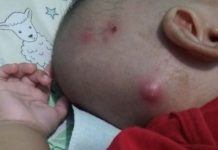 Perhatikan Penyebab dan Gejala Penyakit Bisul, Juga Cara Mengobatinya