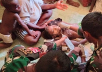 Dramatis, Satgas Pamtas RI-PNG Selamatkan Bocah Papua Kritis Akibat Luka Bakar