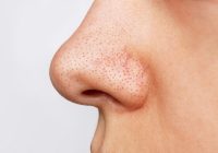 5 Cara Hilangkan Komedo dengan Alami