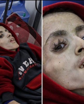 Gaza Kelaparan Akut, Beredar Potret Bocah Gaza Meninggal Dunia Akibat Dilaparkan Penjajah Israel, Ini Kata WHO