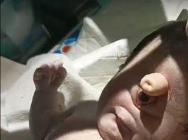 Bayi Laki-laki Bermata Satu Lahir Sumatera Selatan Dinyatakan Meninggal Dunia, RSUD Sekayu Buka Suara