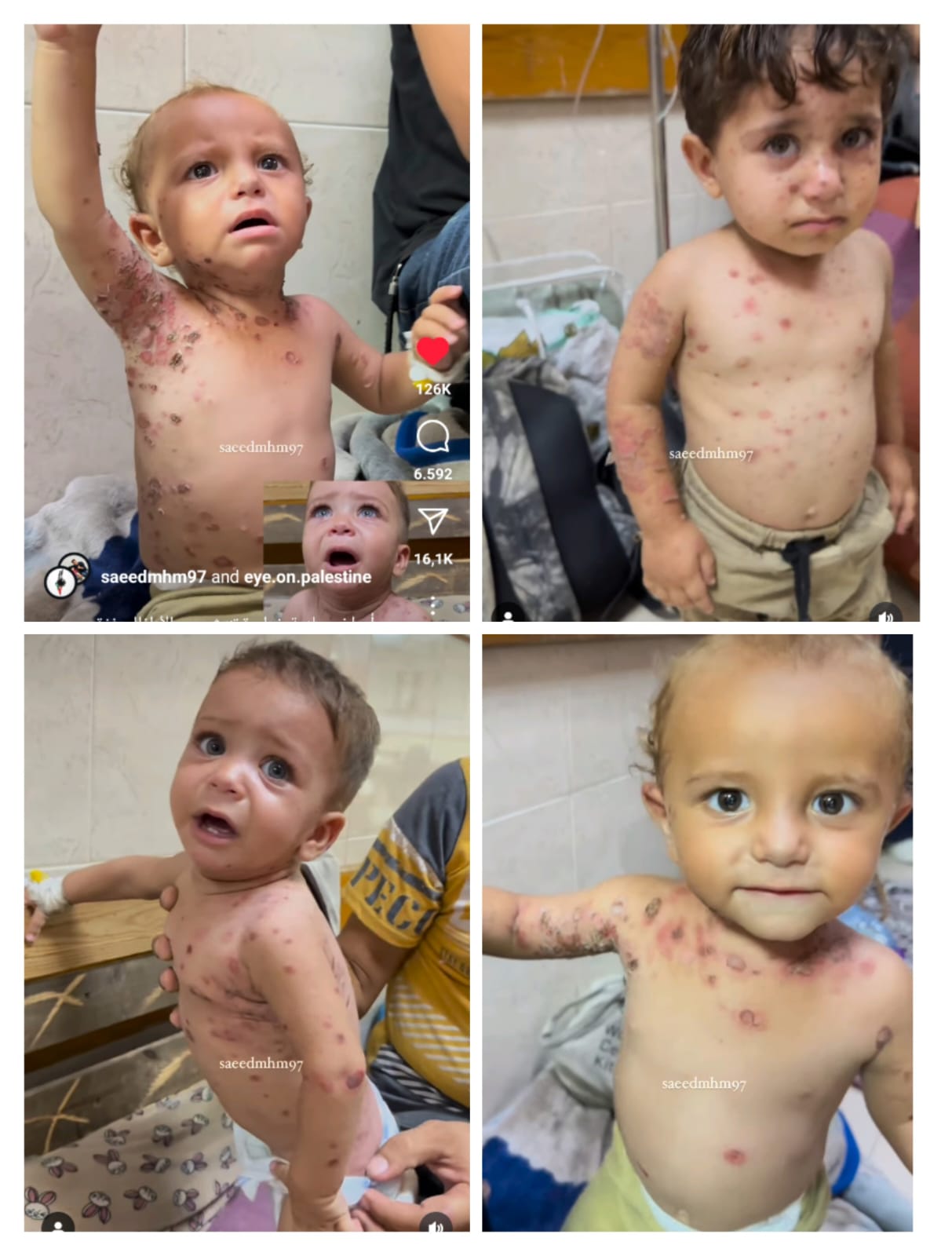 Selain Virus Polio, Anak-anak Palestina Juga Terancam Alami Penyakit Kulit Akibat Penjajahan Israel