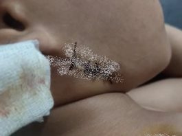 Anjing Liar Resahkan Warga Balangan, Serang Anak-anak Hingga Mendapatkan Jahitan di Leher