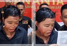 VIDEO VIRAL! Disiram Air Keras oleh Suami, Perempuan Ini Terlilit Utang Rp400 Juta karena Tak Ditanggung BPJS