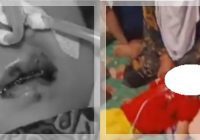 MENGERIKAN! Balita Raya Tubuh hingga Otak Dipenuhi Cacing, Sudah 1 Kg Dikeluarkan tapi Tak Habis-habis