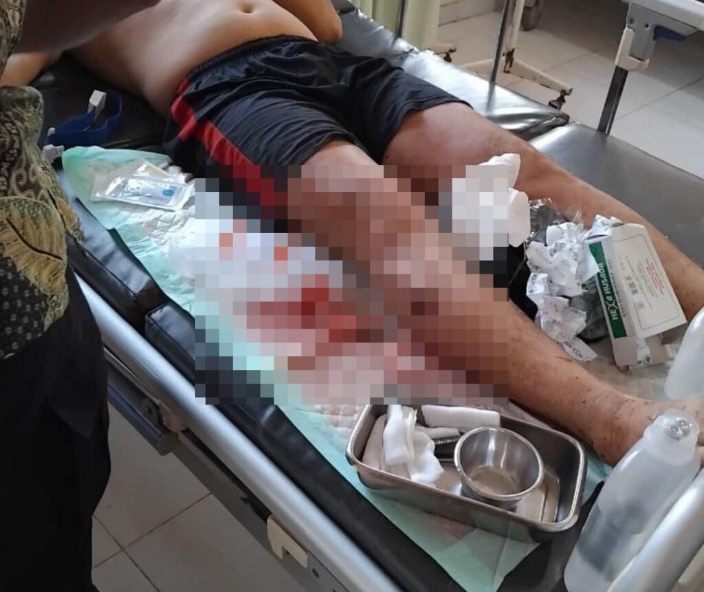 Diserang Buaya Saat Cari Ikan di Sungai, Satpam Perusahaan Sawit di Kobar Dapat 40 Jahitan